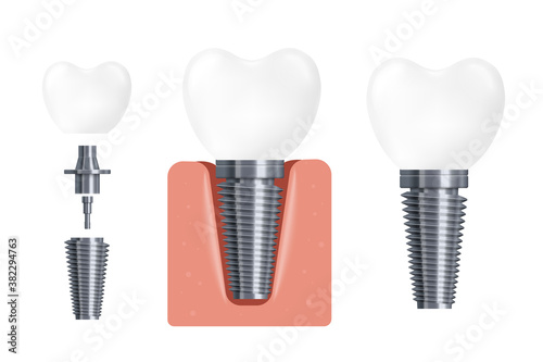 Dental implant construction, flat cartoon vector illustration isolated