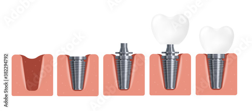 3d realistic vector illustration of dental implant installation steps.