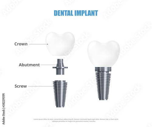 Realistic 3d vector illustration dental implant structure