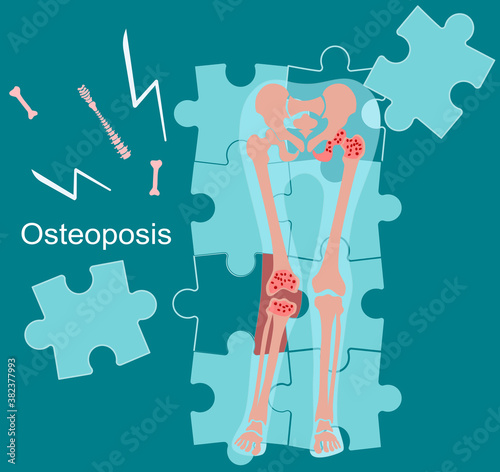 World Osteoporosis Day concept.Arthrosis human legs.Hip joint disease and pain.Fragile and broken knee bones falls apart by puzzles.Movement disability and rheumatism.Vitamin D calcium deficiency