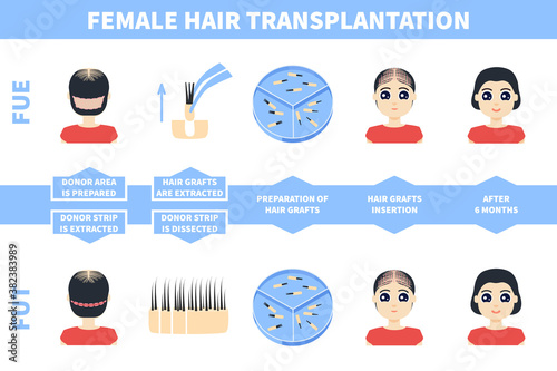 Female alopecia treatment with FUE and FUT methods. Follicular unit extraction versus follicular unit transplantation. Hair transplant stages. Medical infographics. Vector illustration.