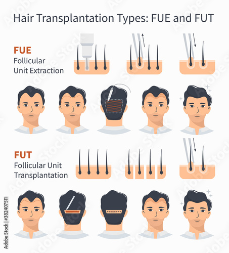 Types and stages of hair transplantation FUE and FUT Follicular Unit Extraction. Treatment of baldness, alopecia, mens hair loss. Vector medical infographics, a male head scalp. Strip, graft machine. photo