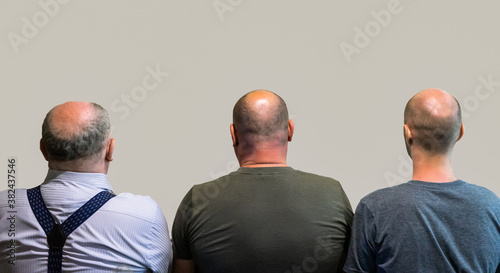 Bald men rear view, head with hair loss. The concept of hereditary hair loss.