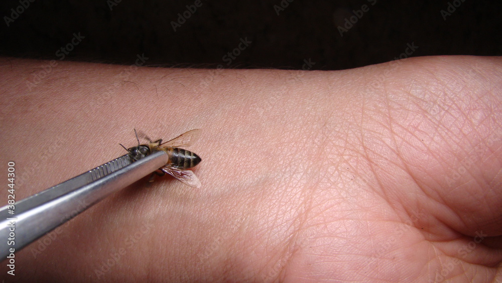 Obraz premium bee : apis mellifera treatment by honey bee sting closeup honey bee stinging a hand close up bee worker insects, insect, animal, wildlife, wild nature, forest, woods, garden beauty of pollination