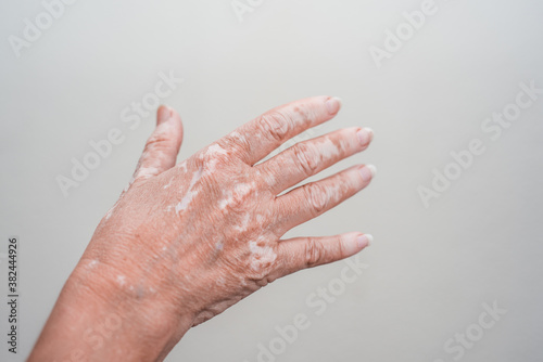 Vitiligo skin problem on woman's hand closeup on isolated background. © JoseManuel