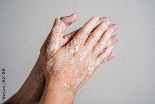 Hands with vitiligo skin problem clapping on isolated background.