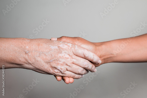 Young woman's hand holding an older person's hand with vitiligo disorder.