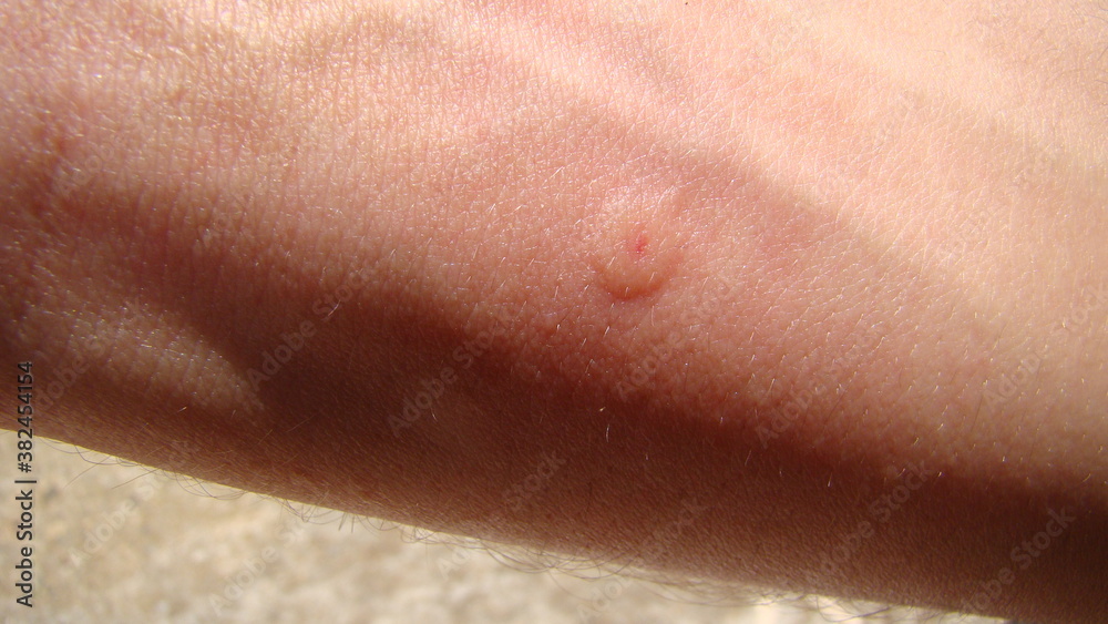 Fototapeta premium bee : stung by a bee worker. skin allergy , allergic treatment by honey bee sting closeup honey bee stinging a hand insects, insect, animal, wildlife, wild nature, forest, garden beauty of pollination