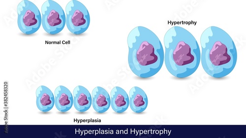 Cells showing hyperplasia and hypertrophy property.  photo