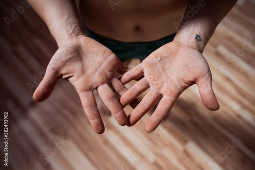 Calloused Hands of a Gymnast