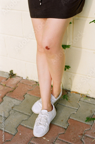 Young woman with scraped knee photo