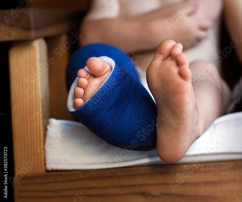 Close Up Of Legs and Feet With Blue Cast