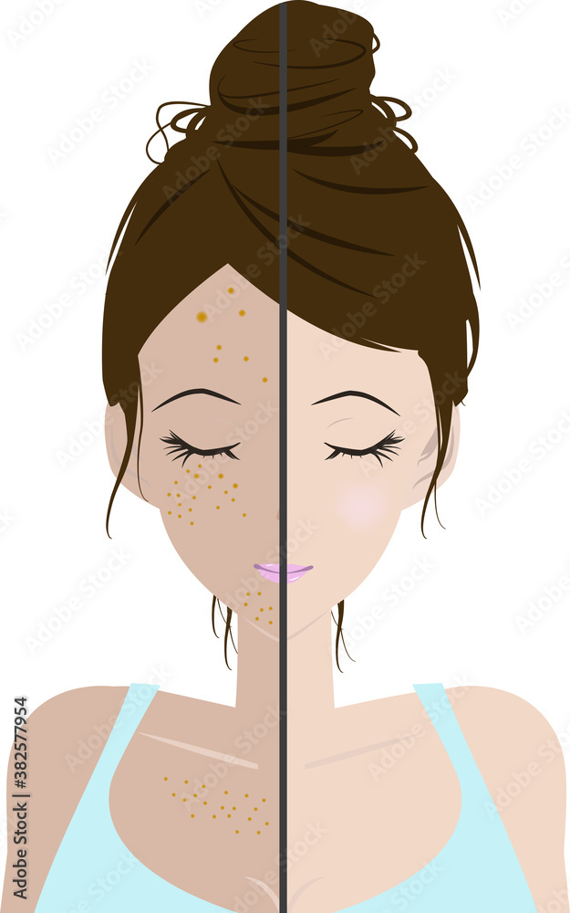 シミのある顔とシミのない顔の比較のイラスト Stock Vector Adobe Stock