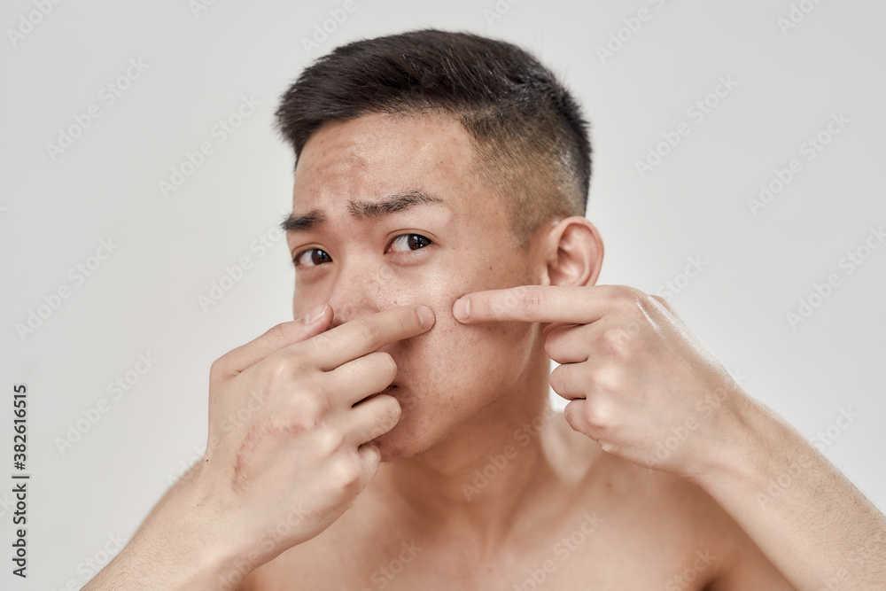 Close up portrait of shirtless young asian man with problematic skin ...