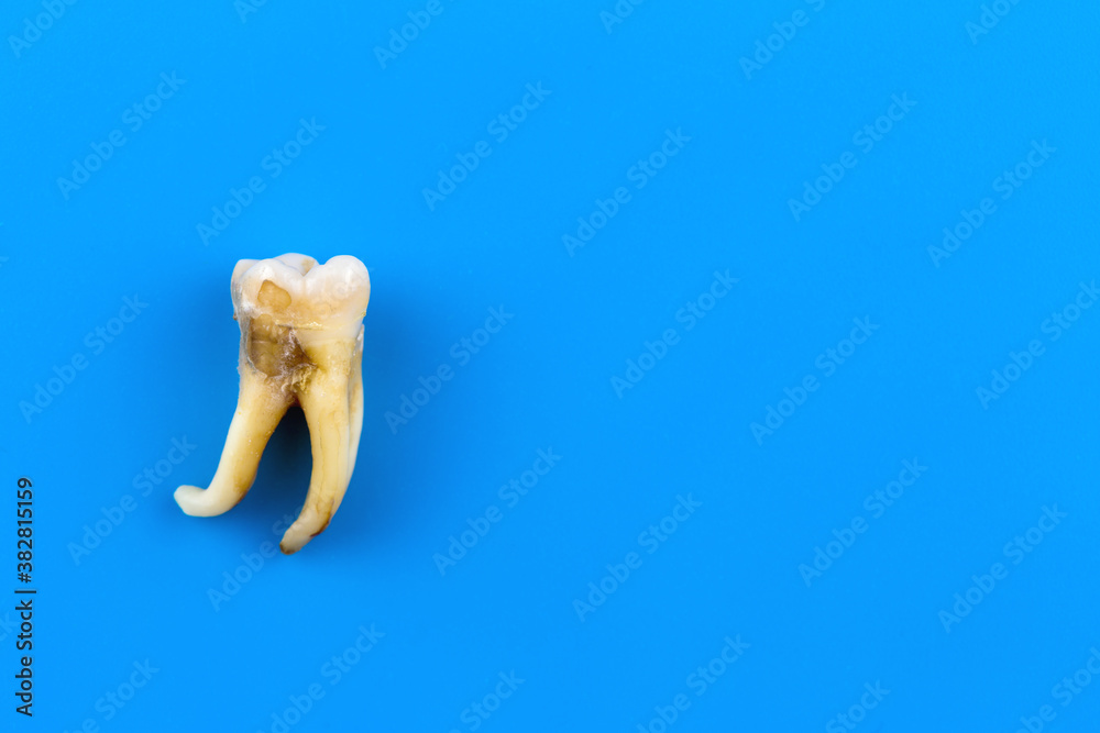 Fotka „A real human tooth is affected by caries and with a curved root