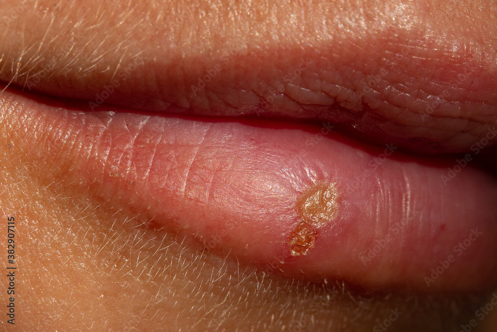 Obraz premium Macro of a woman's lip fever infection