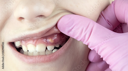 Photos The child has swollen gums with hematoma and fistula