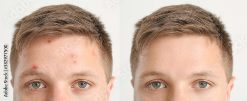 Teenage boy before and after acne treatment on light background, closeup