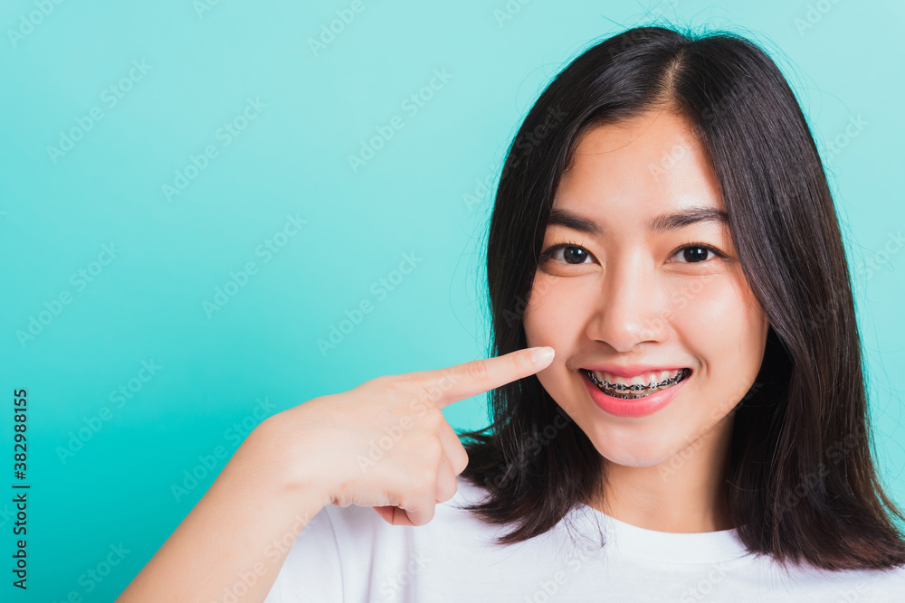 Portrait of Asian teen beautiful young woman smile have dental braces on teeth laughing point finger her mouth, studio shot isolated on a blue background, Medicine and dentistry concept Portrait of Asian teen beautiful young woman smile have dental braces on teeth laughing point finger her mouth, studio shot isolated on a blue background, Medicine and dentistry concept