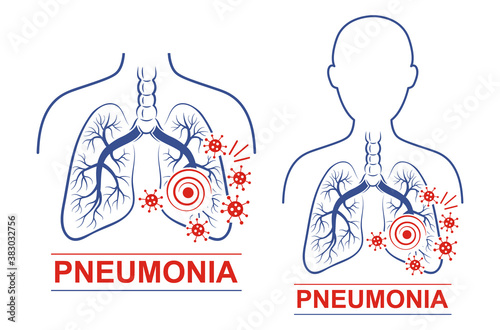 Pneumonia disease icon set. Human lungs and trachea anatomy. Treating for pneumonia. Treatment for coronavirus or bacterial attack of respiratory system. Flat vector for medicine packaging design