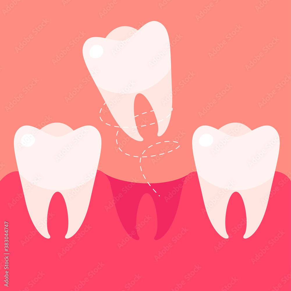 Tooth extraction, denture flat cartoon illustration. Wisdom tooth removal medical banner. Dentistry, orthodontist design background. Stock Vector | Adobe Stock Tooth extraction, denture flat cartoon illustration. Wisdom tooth removal medical banner. Dentistry, orthodontist design background. Stock Vector | Adobe Stock