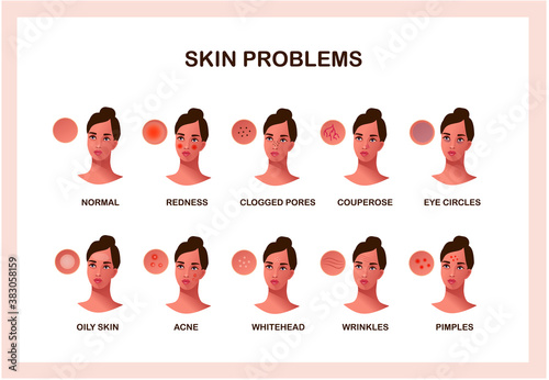 Skin conditions and problems vector infographics, skincare and dermatology concept. Beautiful face.