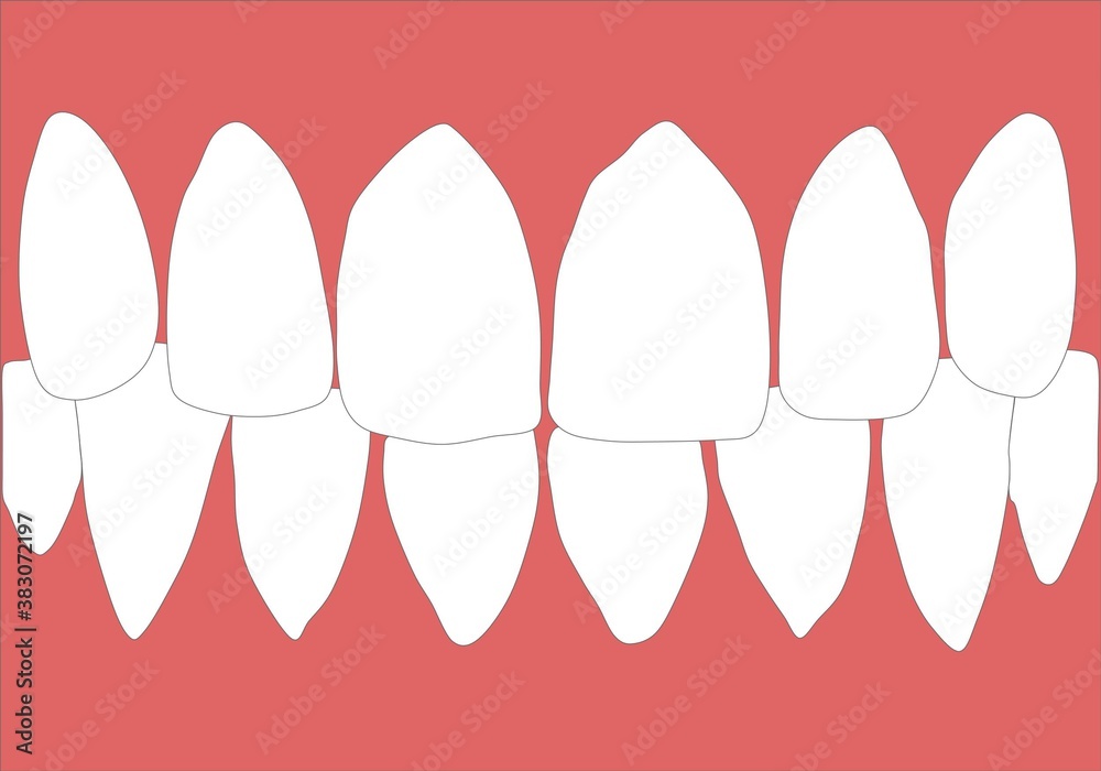 Dentures With White Teeth. The Gums Of The Upper And Lower Jaw Isolated On A White Background. Vector Illustration. Stomatology Dentures With White Teeth. The Gums Of The Upper And Lower Jaw Isolated On A White Background. Vector Illustration. Stomatology