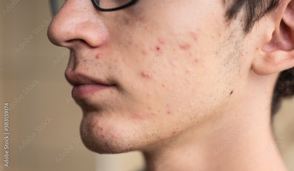 Fototapeta premium Close-up portrait on the skin of a young Caucasian boy in pubertal age: on his skin there are several recognizable pimples at different times of their life cycle. Selective focus.