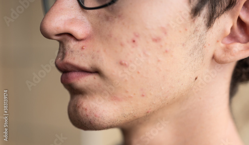 Close-up portrait on the skin of a young Caucasian boy in pubertal age: on his skin there are several recognizable pimples at different times of their life cycle. Selective focus. photo