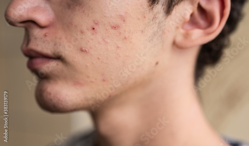 Close-up portrait on the skin of a young Caucasian boy in pubertal age: on his skin there are several recognizable pimples at different times of their life cycle. Selective focus. photo
