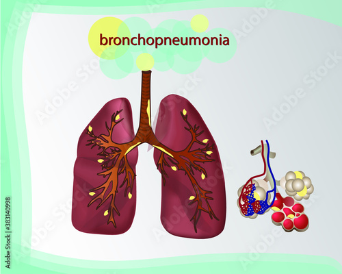 Bronchopneumonia. Vector graphics. The symbol of light. Alveoli. Cancer of the lungs (asthma, tuberculosis, pneumonia). Respiratory system. World day to combat tuberculosis. World pneumonia day. Coron