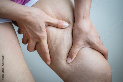 Photos Woman with cellulite (known as orange-peel skin) problem appears on her legs