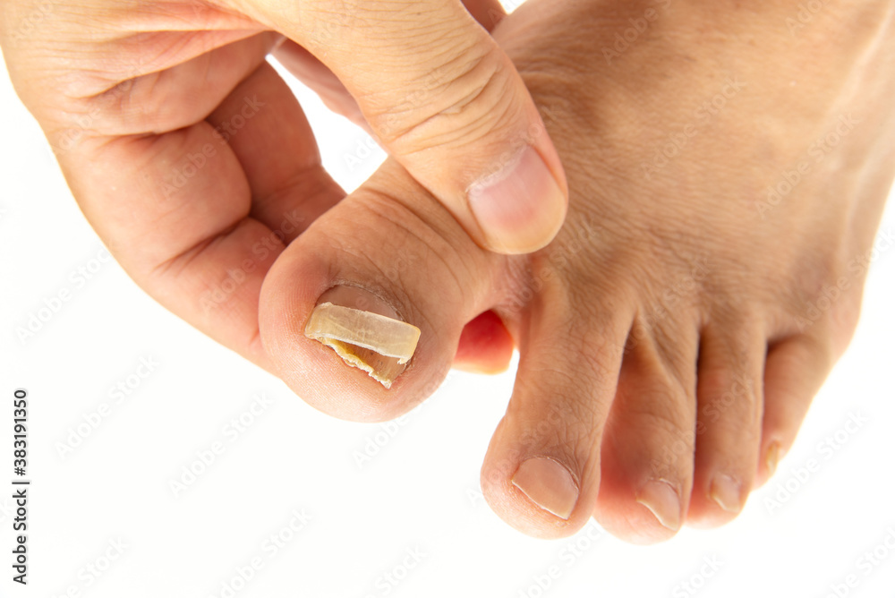 爪水虫で割れた男の足の親指の爪