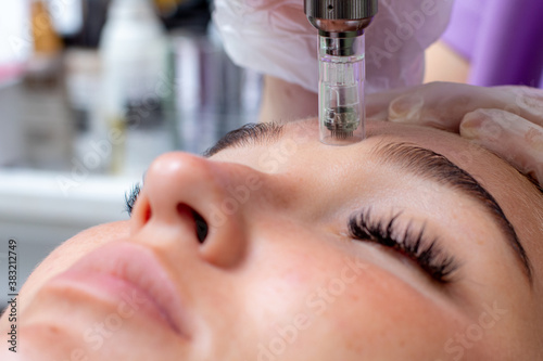 Fractional microneedle facial therapy close up