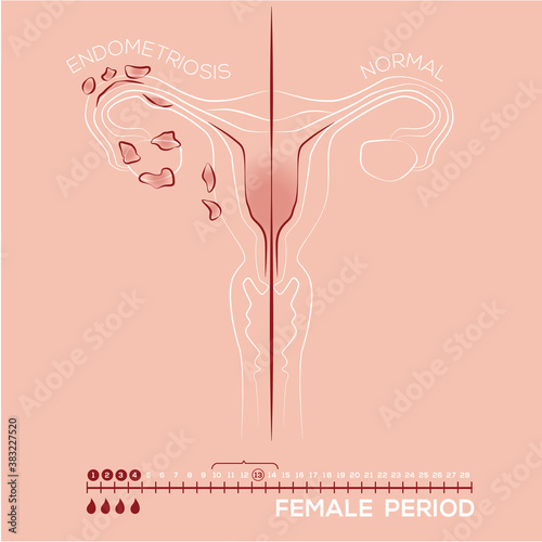 Illustration of endometriosis, endometrial tissue in the uterus, female disease, womens medicine, menstrual period photo