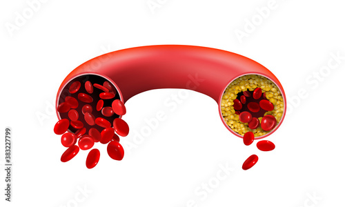 Normal and cholesterol-blocked artery on a white background. Vector illustration