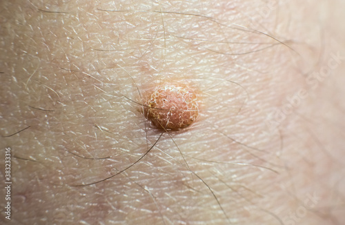 Big birthmark on skin. Medical health photo. Papillomas on human body.