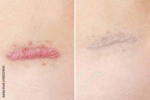 Close up of cyanotic keloid scar caused by surgery and suturing, skin imperfections or defects before and after treatment and laser removal. Hypertrophic Scar on skin, dermatology and cosmetology