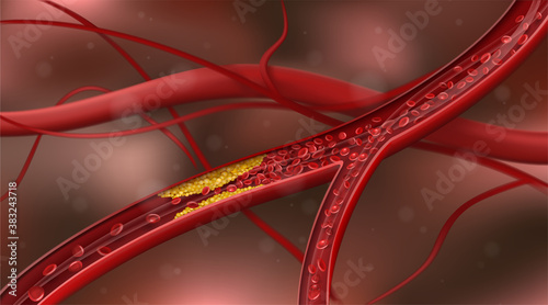 Artery blocked by cholesterol. Vector illustration