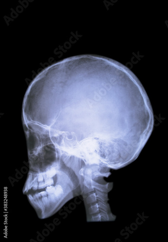 脳のレントゲン写真