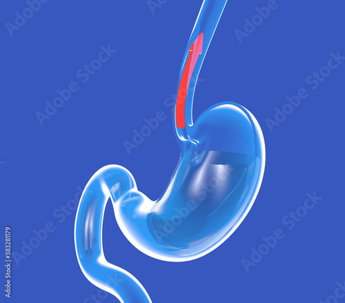 3d illustration of transparent glass stomach showing gastroesophageal reflux. With a red arrow that goes up the esophagus. photo