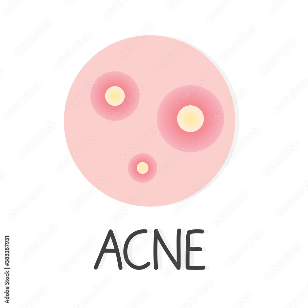 acne, pimple concept- vector illustration acne, pimple concept- vector illustration