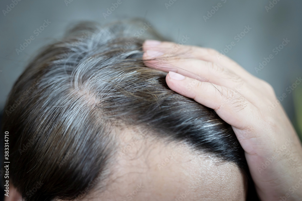 Naklejka premium A man has hair growth, he has hair loss problems. Dry scalp, dandruff