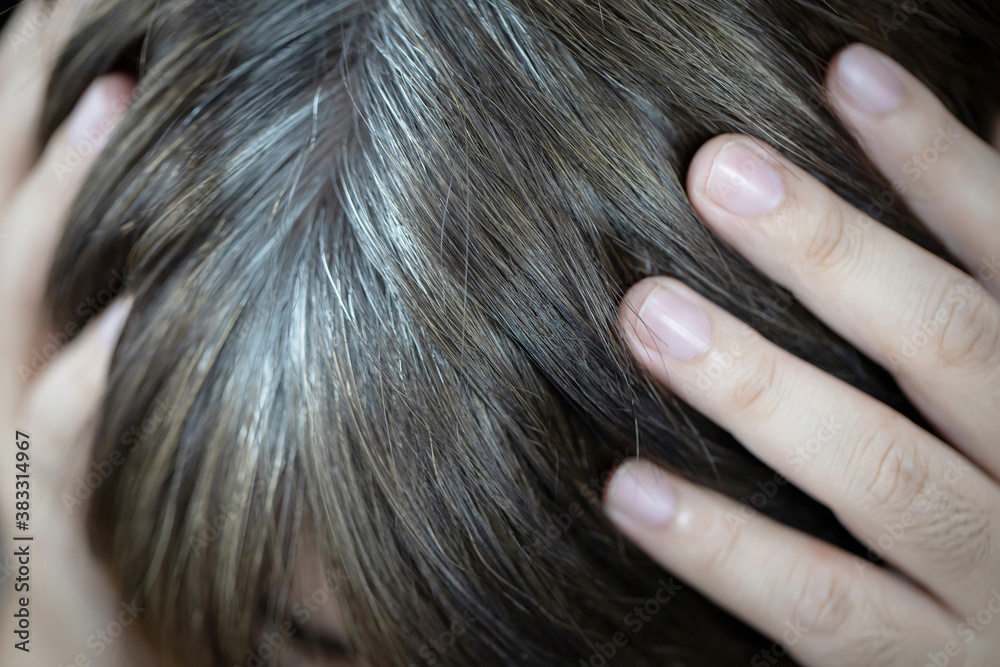 Obraz premium A man has hair growth, he has hair loss problems. Dry scalp, dandruff