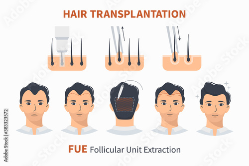 Type and stages of hair transplantation FUE Follicular Unit Extraction. Treatment of baldness, alopecia, mens hair loss. Vector medical infographics, a male head scalp. Strip, graft machine.