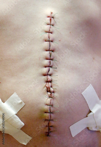 Surgical suture after abdominal cavity surgery, close - up view of surgical suture