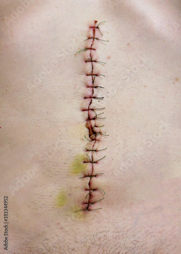 Surgical suture after abdominal cavity surgery, close - up view of surgical suture