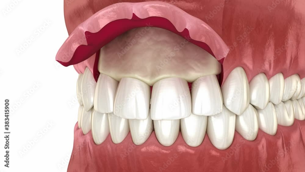 Frontal crown lengthening, Esthetic surgery. Medically accurate dental 3D animation