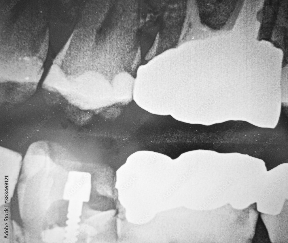 Grainy dental xray image of multiple teeth with fillings and one with
