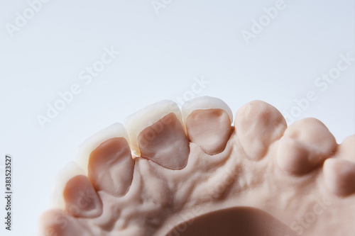 Ceramic dental veneers. Close-up view of dental layout of lower row of teeth prothesis on artificial jaw, medical concept. Shallow dof.